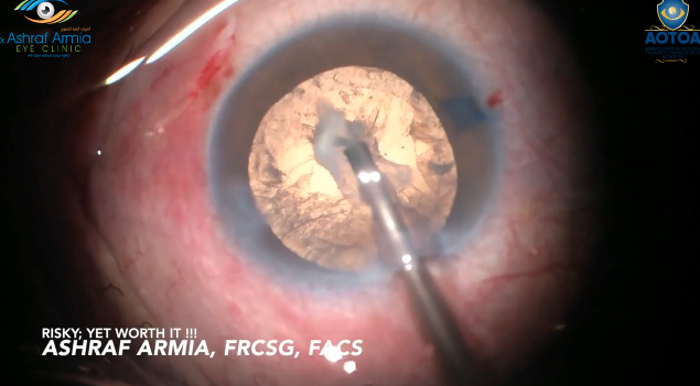 My Peeling Technique for a Dense Plaque on the Posterior Capsule