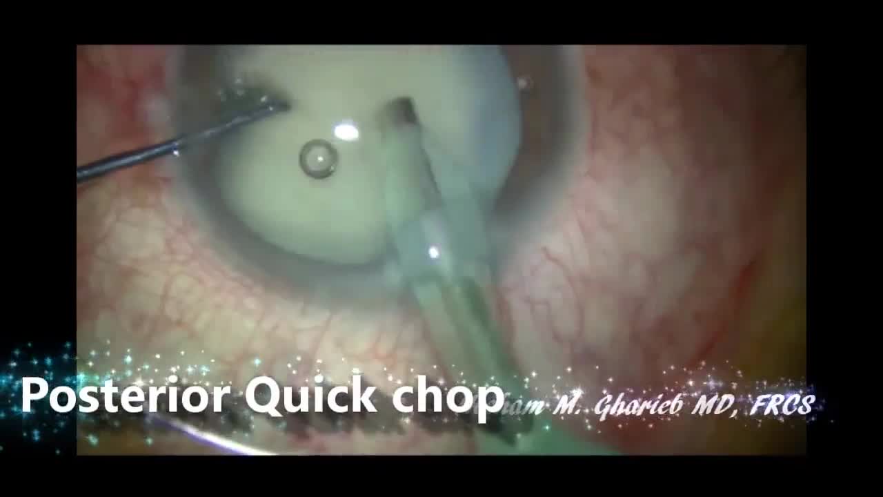 White Cataract: The Safe Surgery