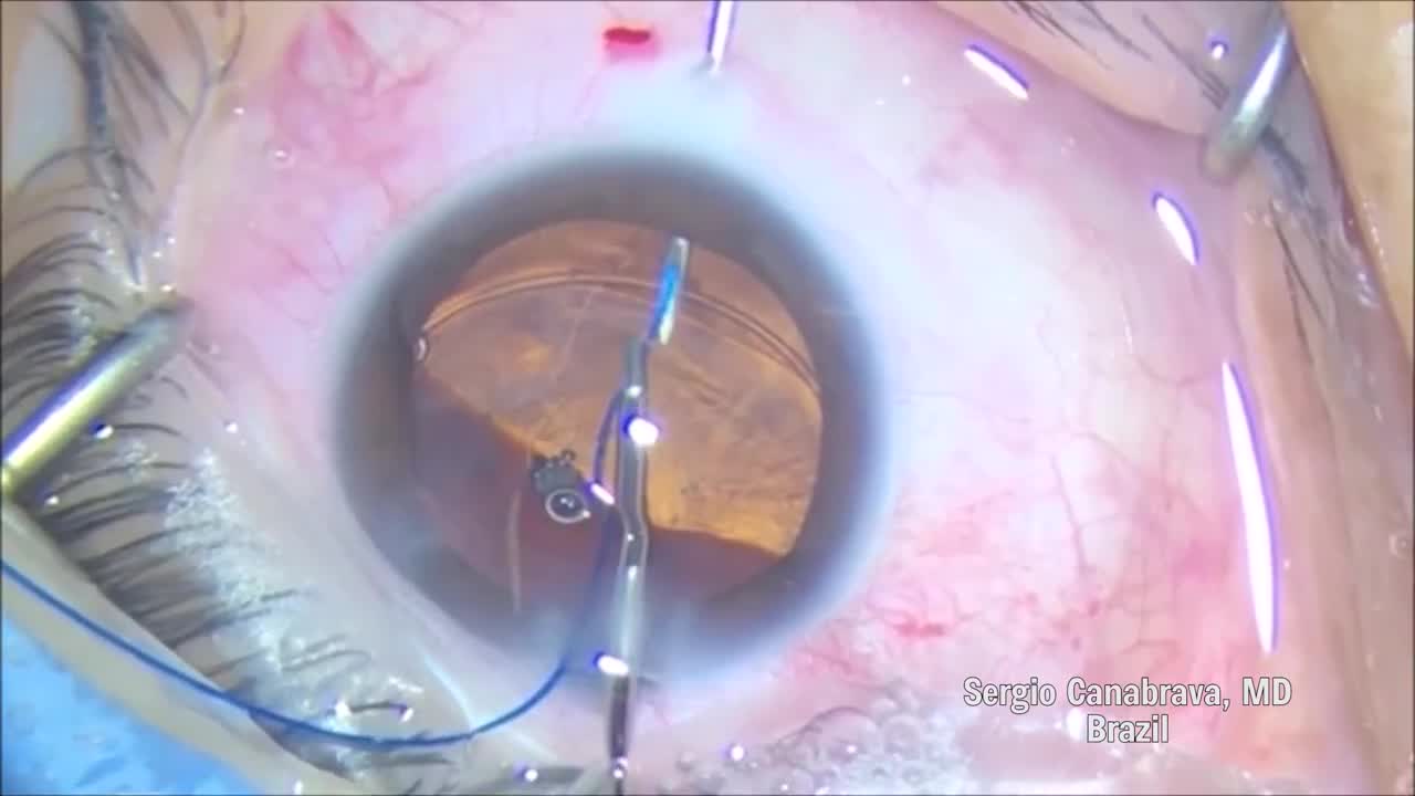 New Management for Marfan Syndrome - Canabrava Technique