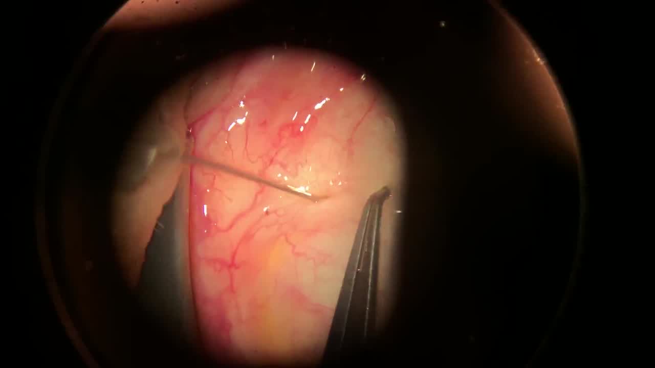 Intravitreal Injection Technique