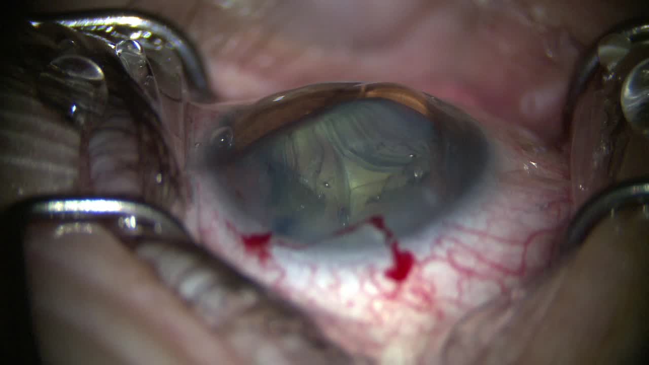 Standard iStent Inject Procedure