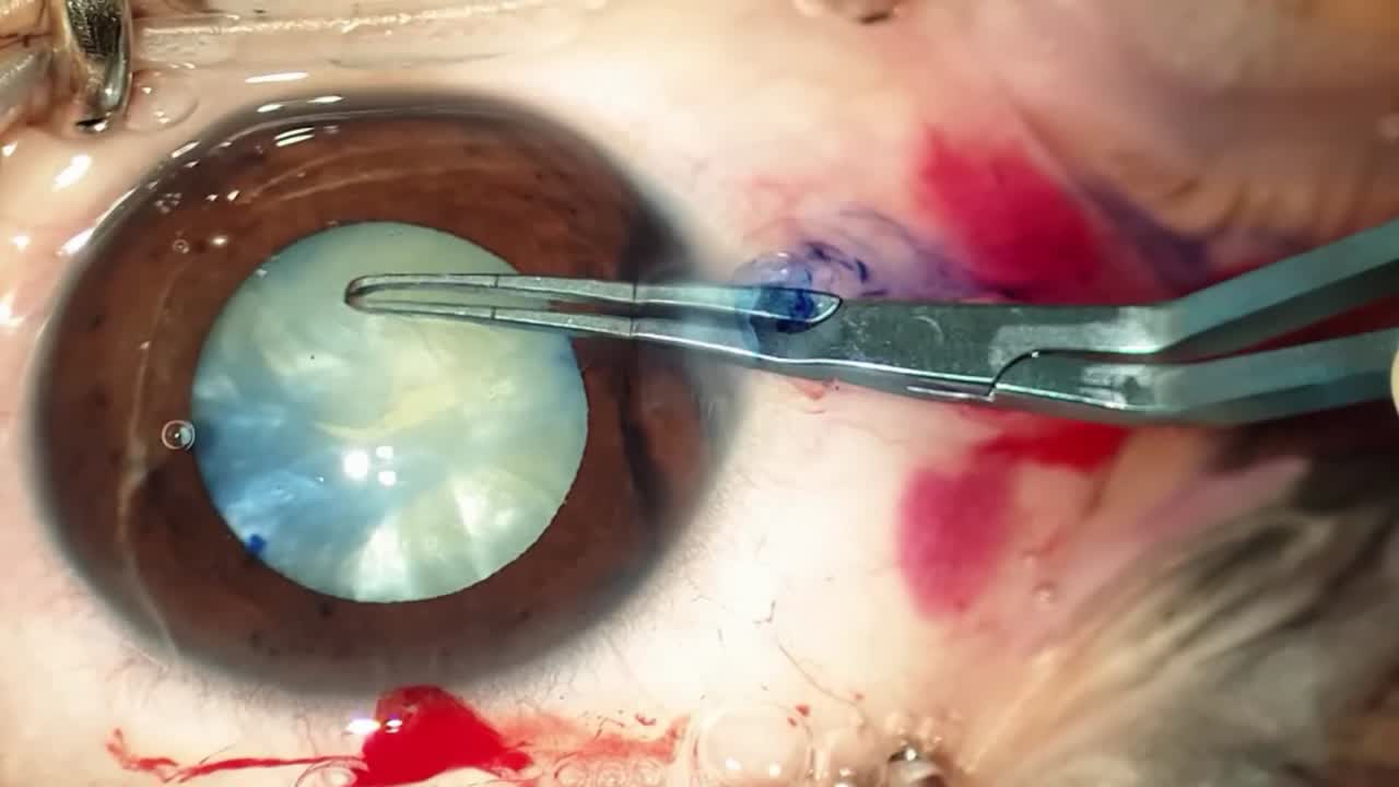 Automated Needle Aspiration to Prevent Argentinian Flag Sign