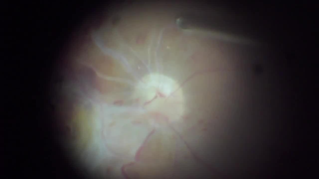 Selective Retinotomy Under Mac Lens View for TRD
