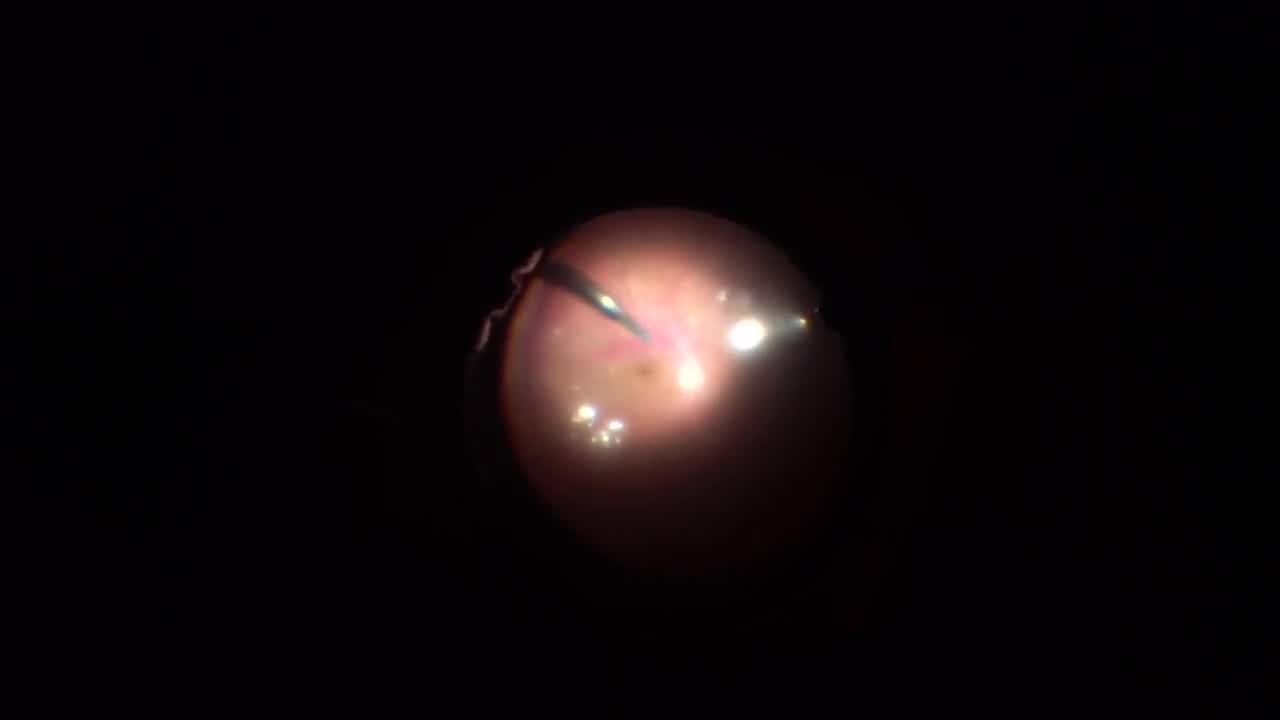 Giant Retinal Tear Management