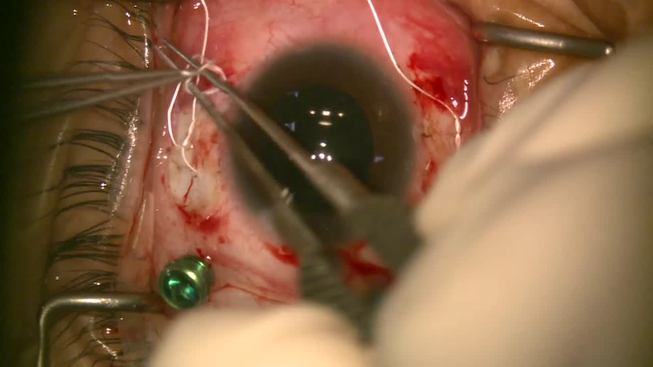 Gortex Fixated IOL in Teen