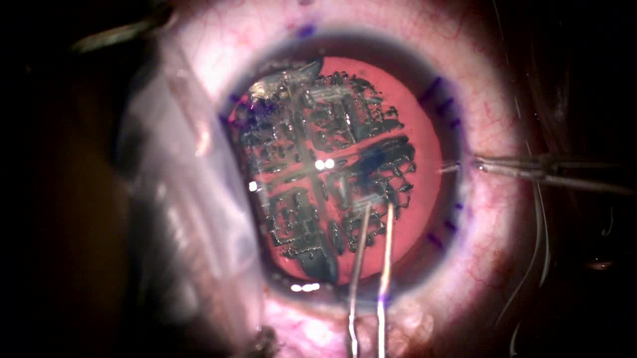 Management of Femtosecond-Assisted Cataract Without Automated Capsulorhexis