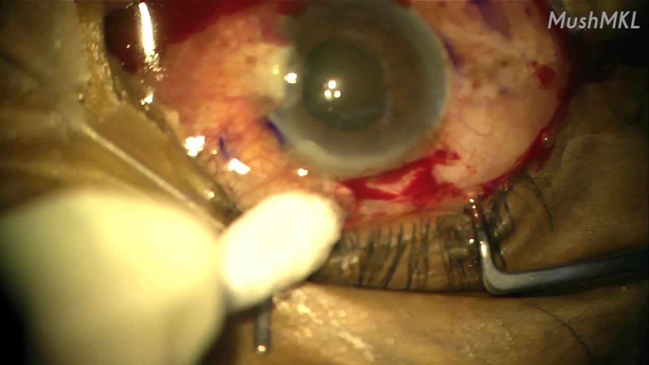 Marking a Sutureless Scleral-Fixated IOL