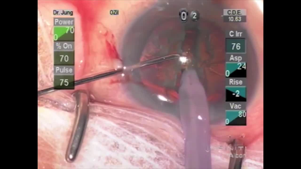 Zero-Min-Spin Cataract Extraction with a Modified Stop-and-Chop Technique