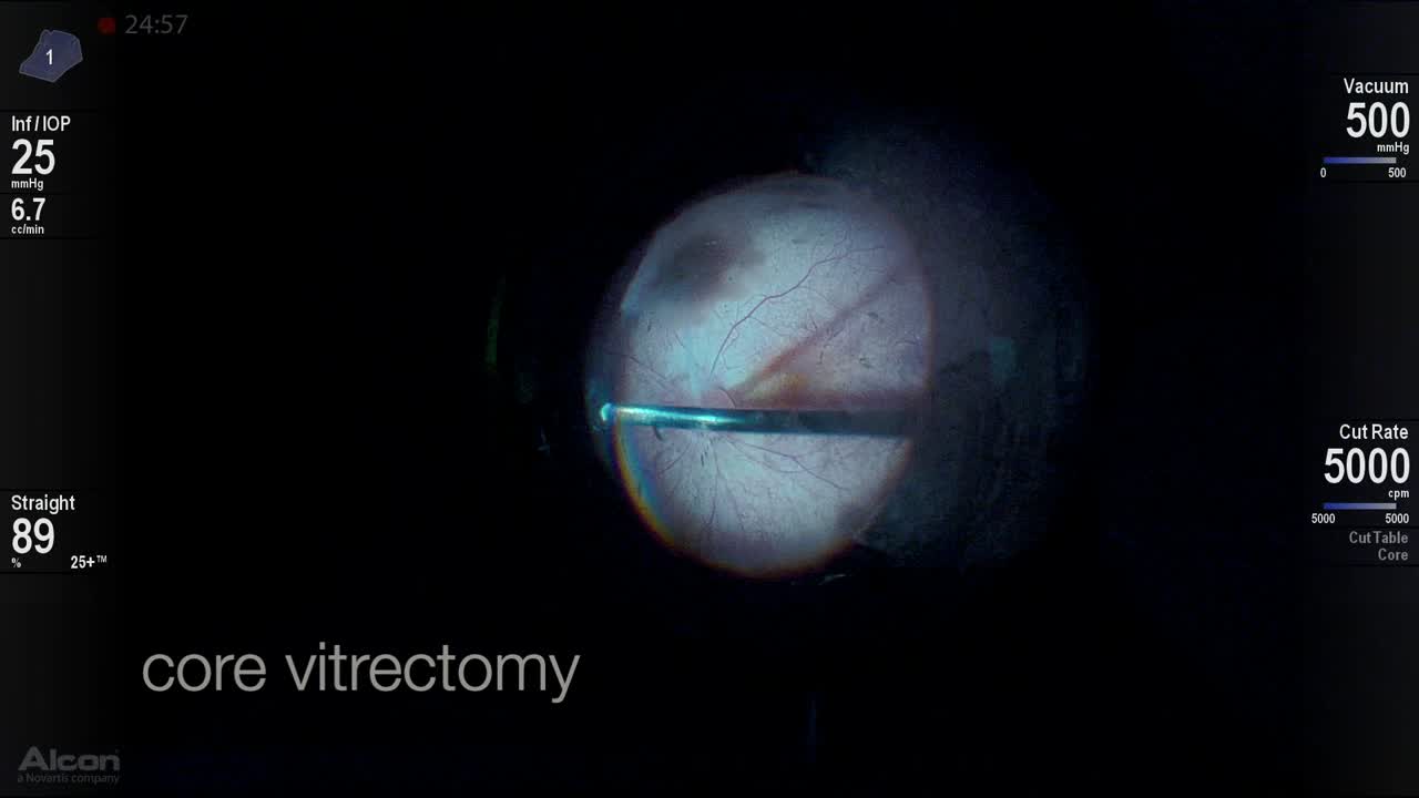 Persistent Fetal Vasculature Syndrome