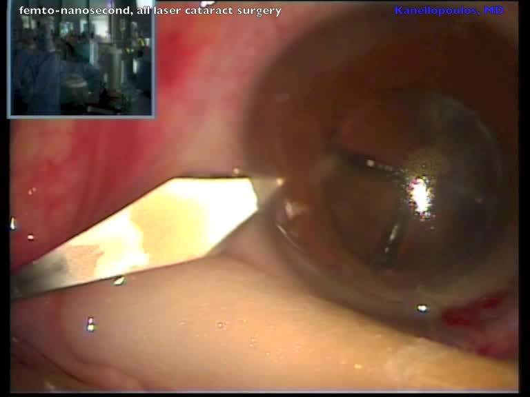 All Laser Cataract Surgery Using The LenSx and CETUS Lasers