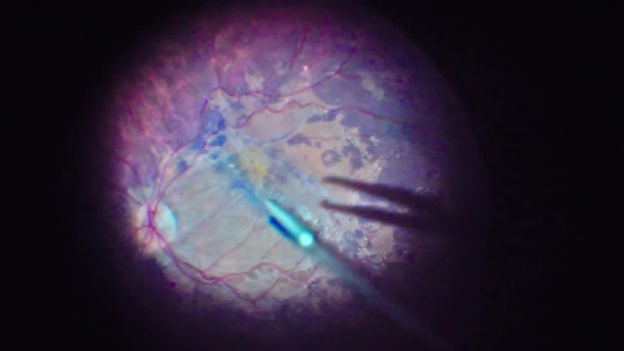 Brilliant Blue-Assisted Technique for Adherent Epiretinal Membrane Peel