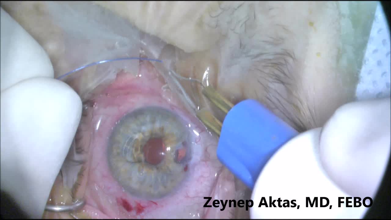 When Suture Stops in Prolene GATT 