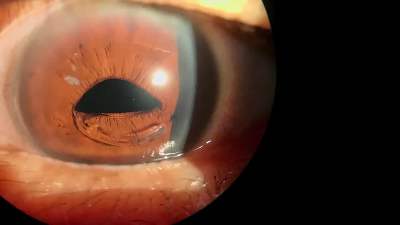 Suture Fixation of Subluxed Symfony IOL In-the-Bag