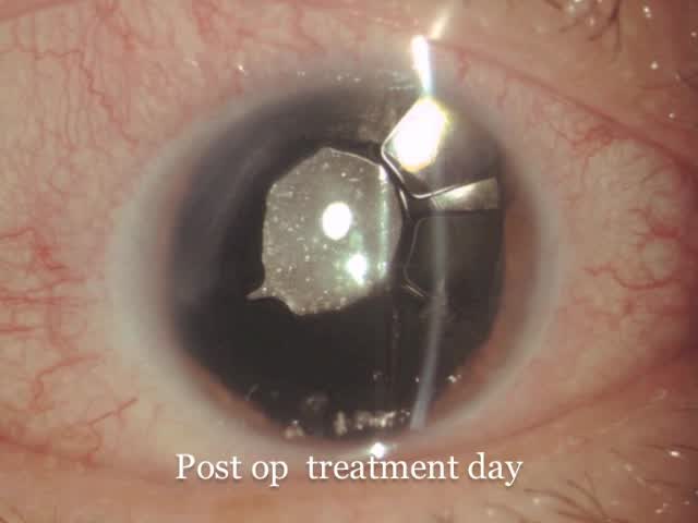Cataract Extraction and Aniridia Capsular Ring Implantation