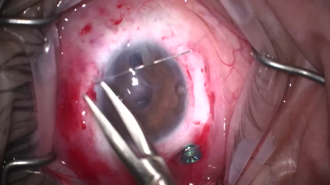 Traumatic Aphakia, Sutured IOL, Pupilloplasty