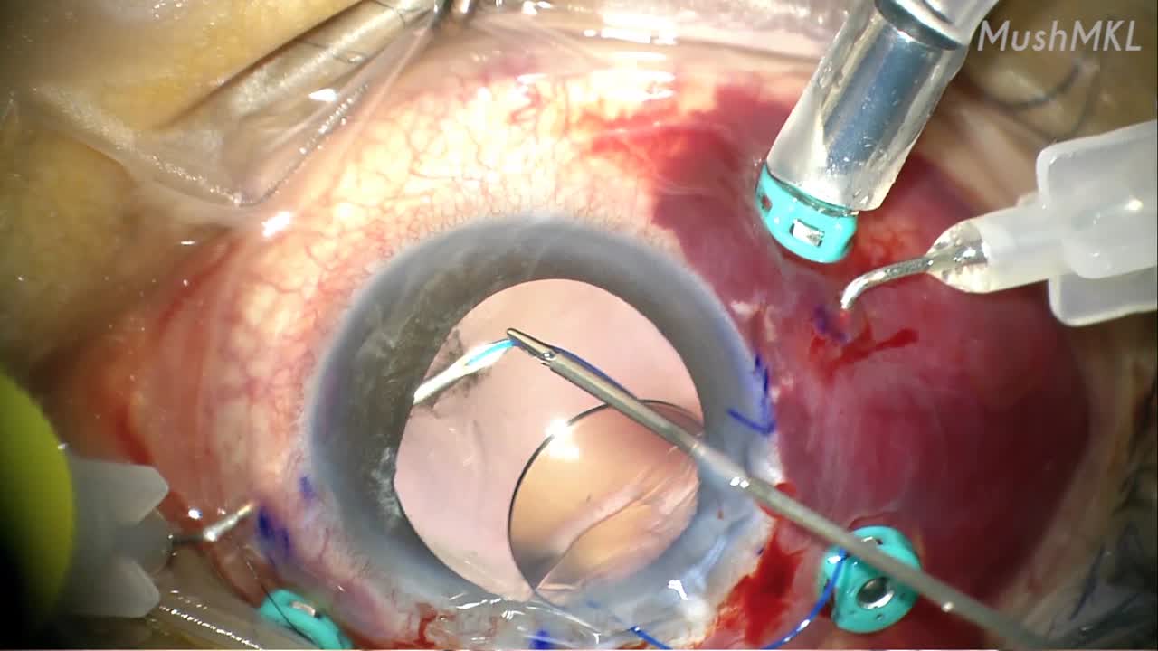 Using the Yamane Technique for Scleral-Fixated IOL