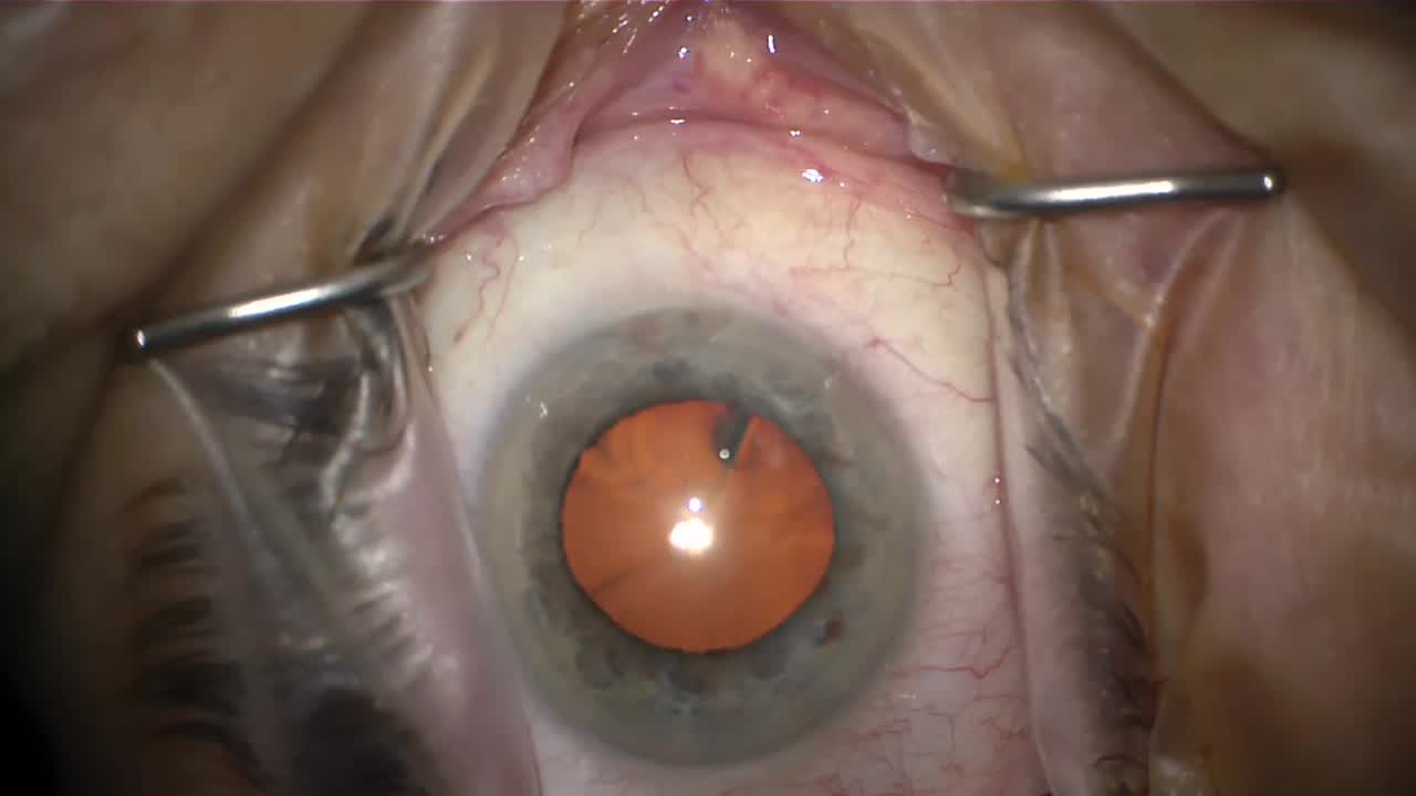 Hydrus Compilation: Tips for Successful Implantation