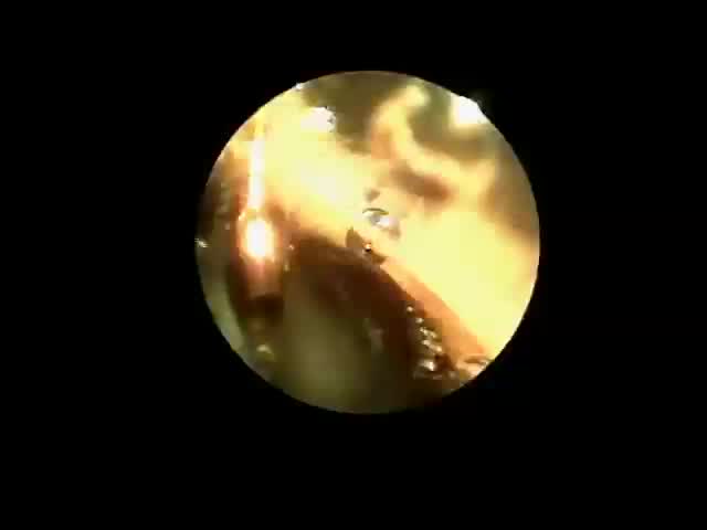 An Endoscopic View of Cataract Surgery