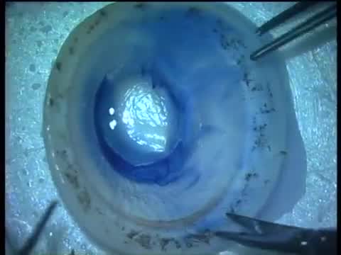 Pre Descemets Endothelial Keratoplasty PDEK