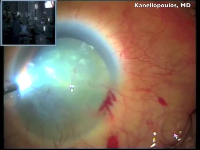 Combined PTK and Clear Cornea Cataract Extraction in a Trachoma Patient