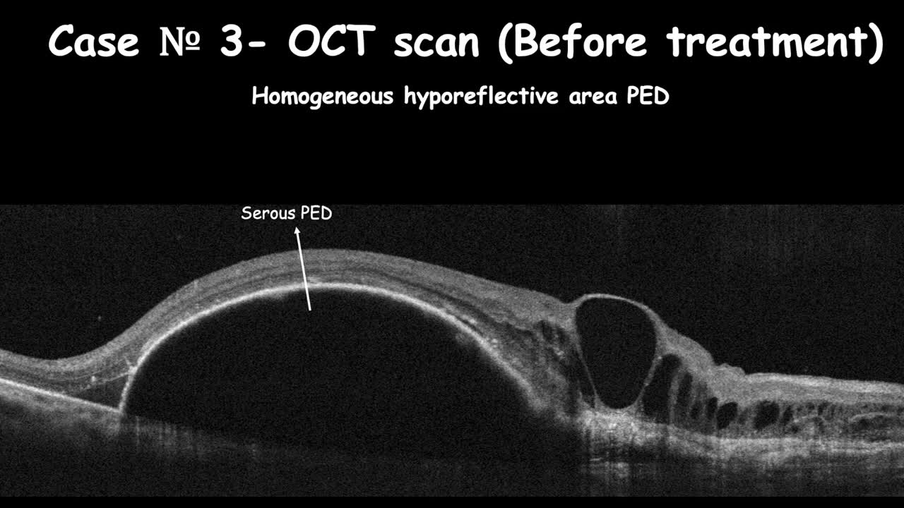 Clinical Changes in RPE Atrophy: Case Report (Part Two)