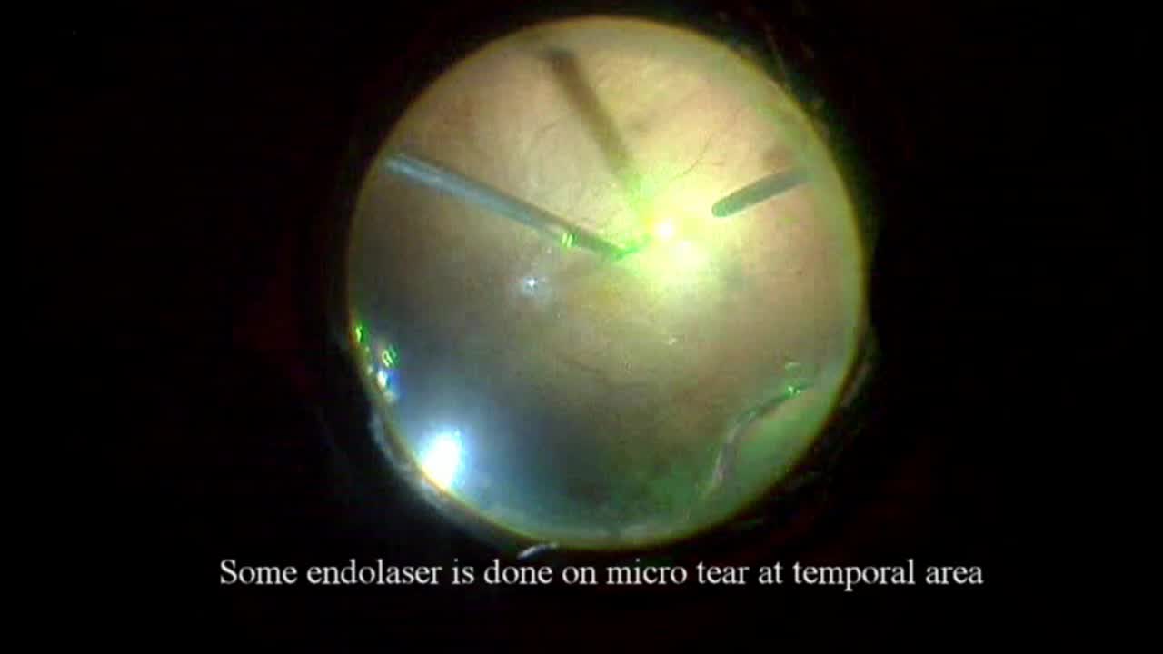 Retinal Detachment With Macular Hole Complicated With Peri Silicone Proliferation