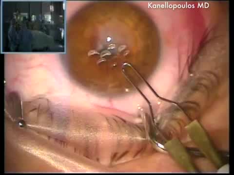 Thermokeratoplasty and PK Hydrops Keratoconus Treatment