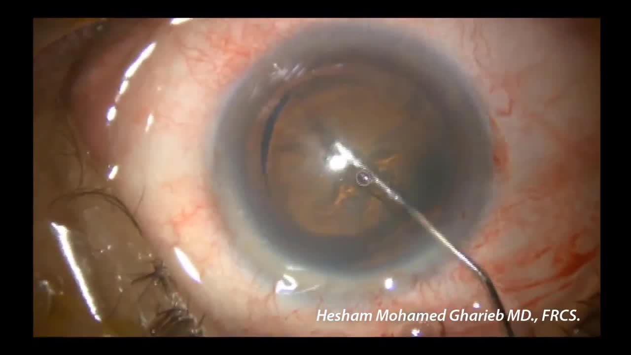Central Hydrodissection and Hydrodelineation During Phacoemulsification