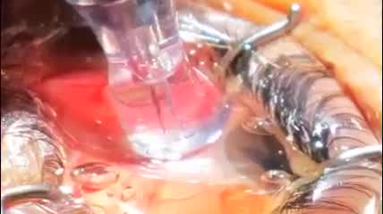 Micropulse Transscleral Cyclophotocoagulation With Direct Visualization of Ciliary Processes 
