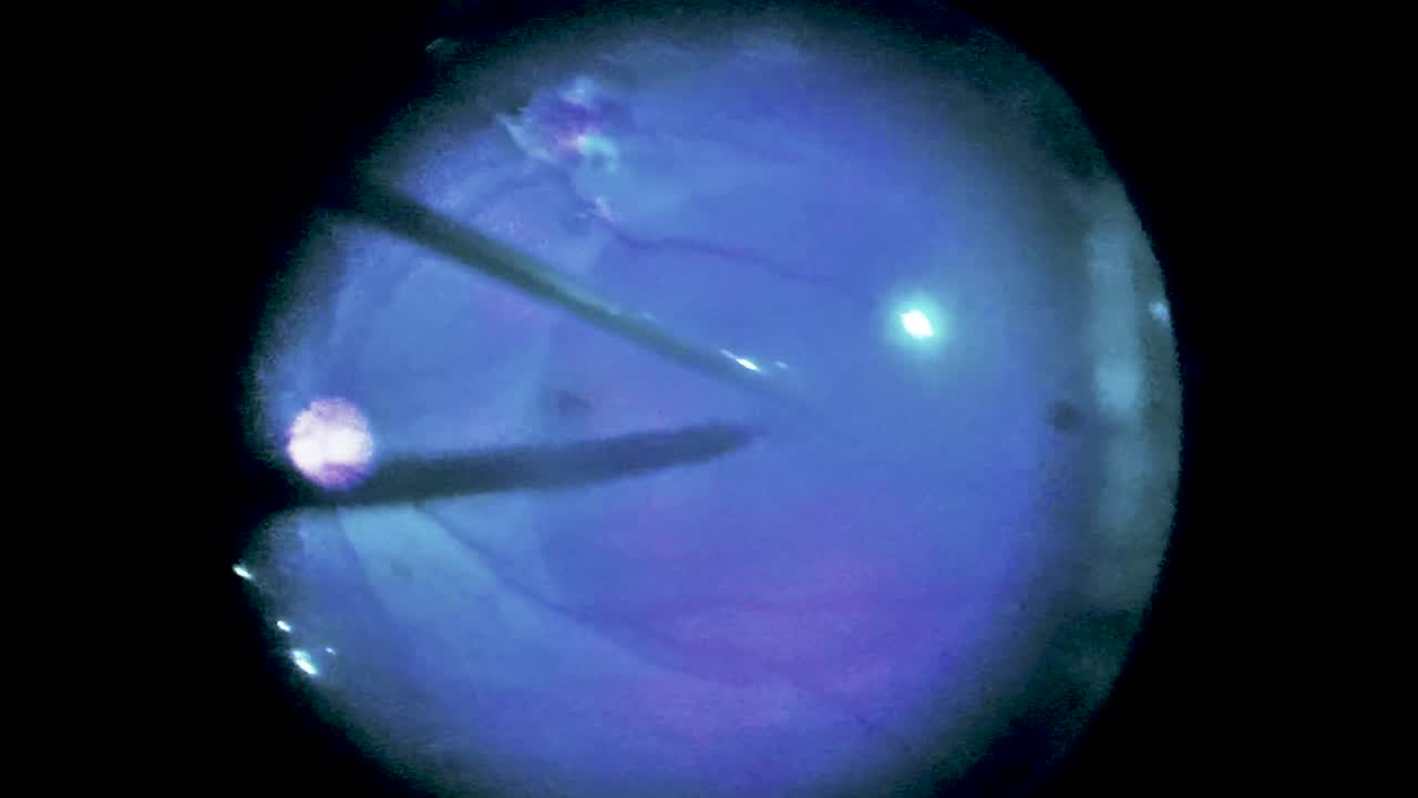Severe Intraocular Gunshot Injury With Metal Foreign Body