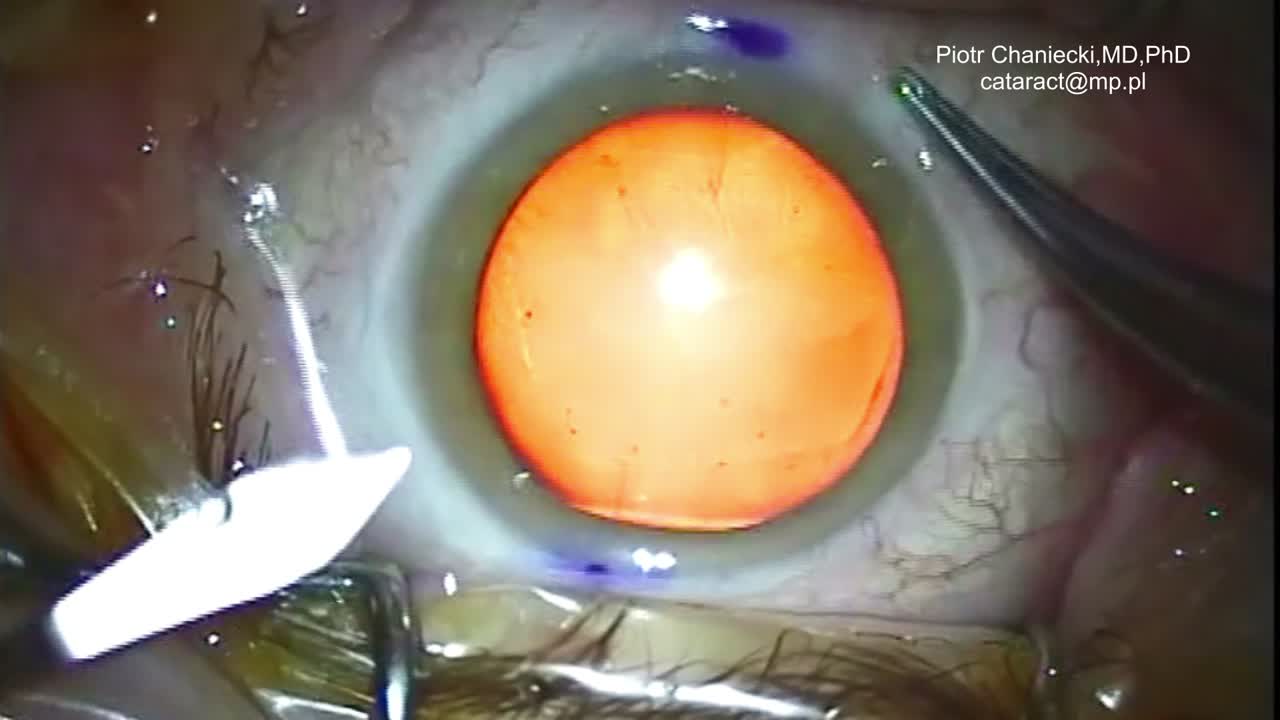 Toric IOL Analog Axis Marking Technique