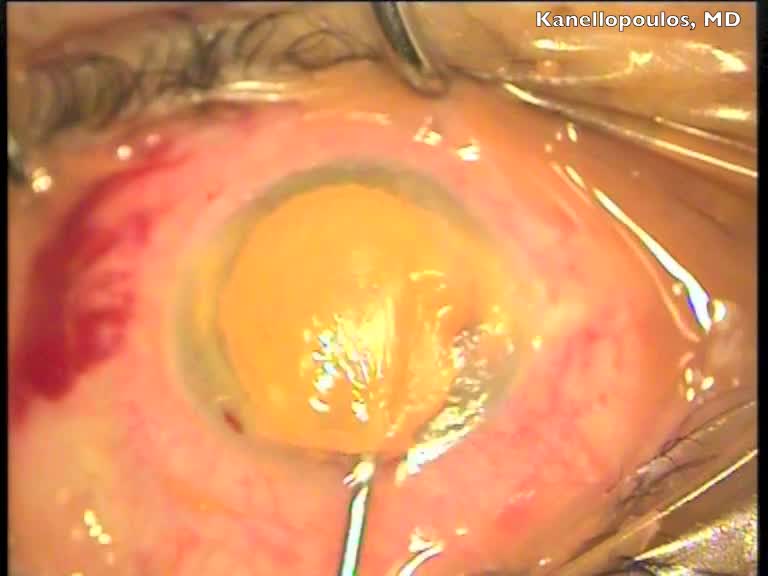 Cosmetic Femtosecond Laser Assisted Cornea Tattooing