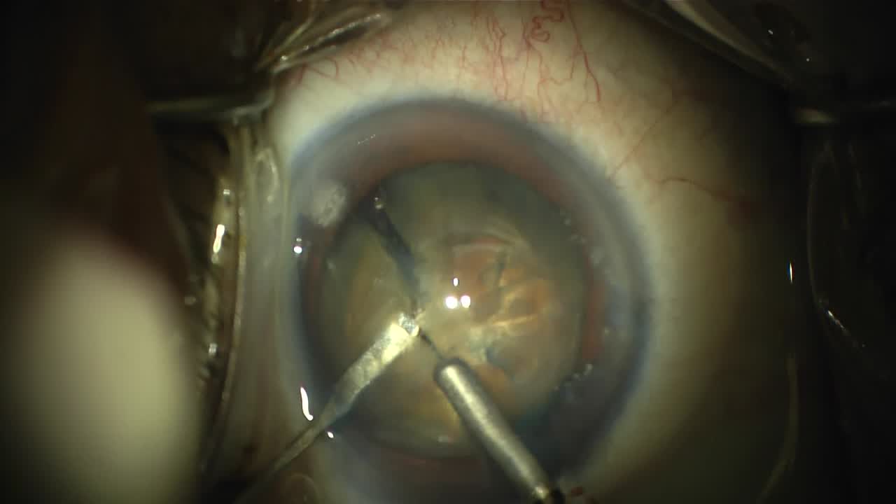 miLoop in brown cataract with posterior plaque