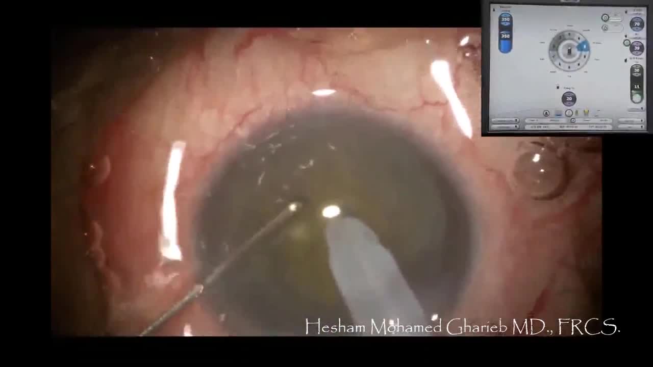 Insulin Tip in Vertical Chopping
