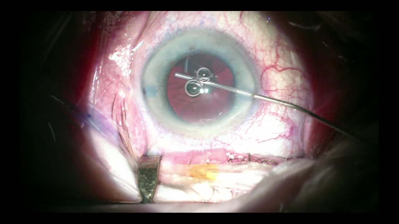 Bimanual Capsulorrhexis