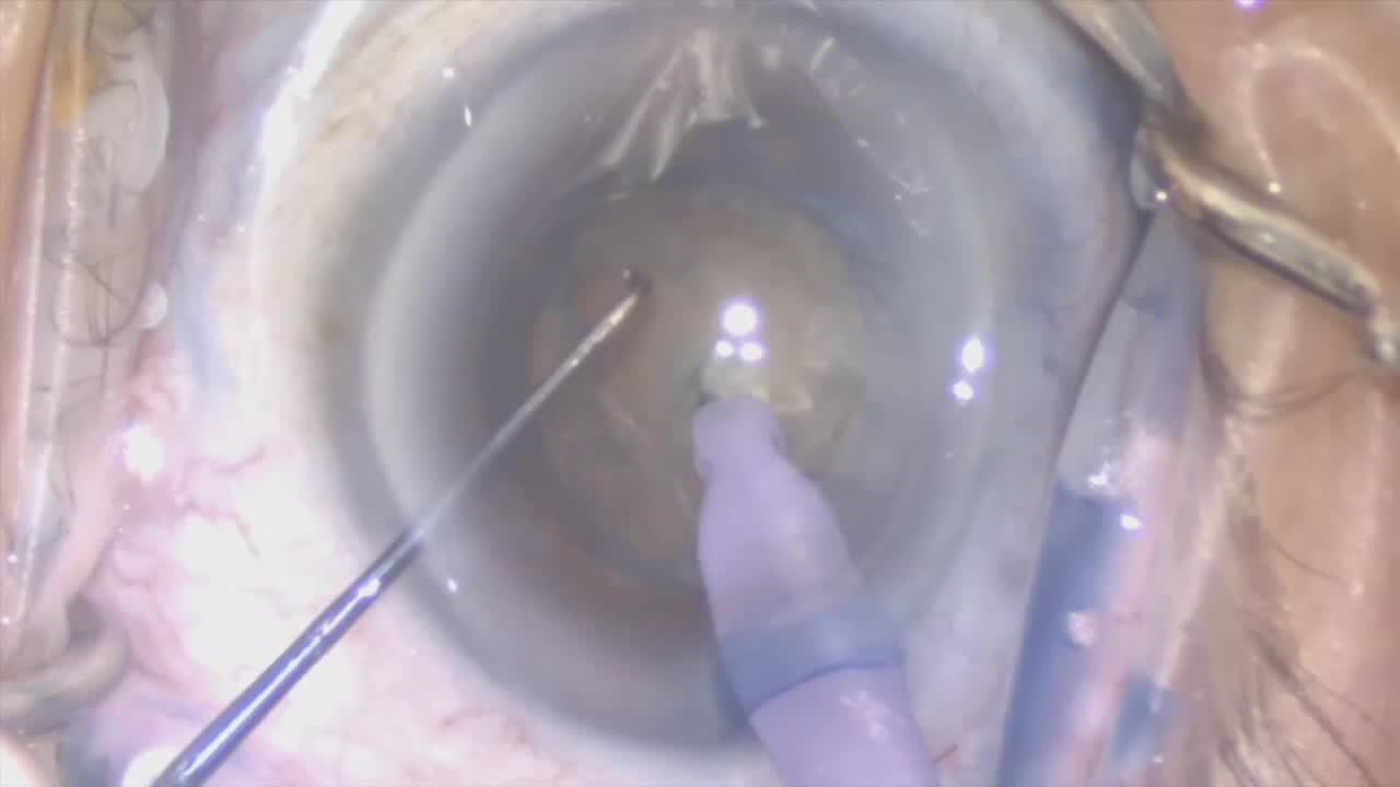 Scleral Sutured MX60 enVista Lens