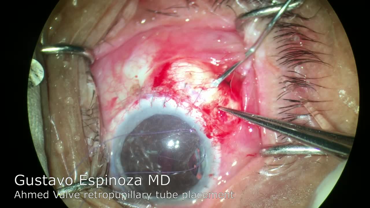 Ahmed Valve Retropupillary Tube Placement