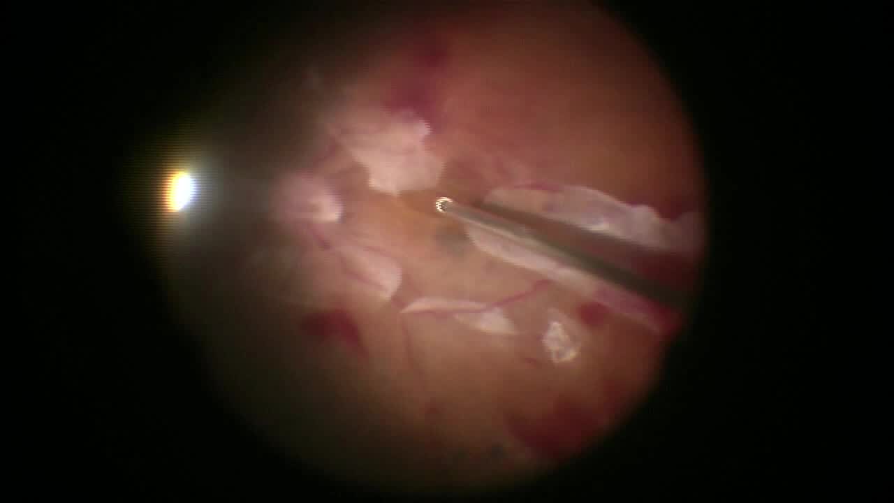Unimanual 27-Gauge Vitrectomy for Tractional Retinal Detachment