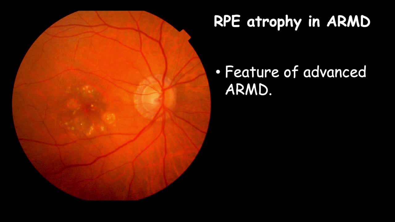 RPE Rip and Atrophy
