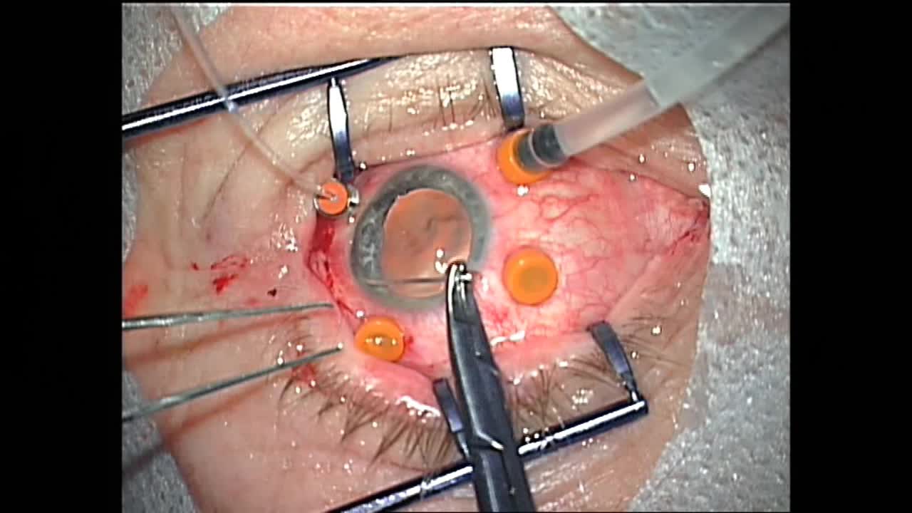 Multimodal Approaches to the Correction of Posttraumatic Eye Changes