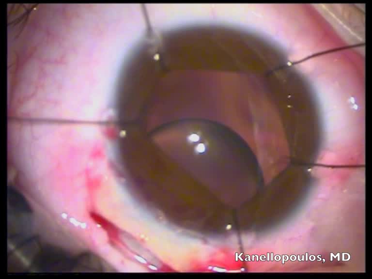 Pediatric Ectopia Lentis Cataract Extraction With Artisan Aphakia IOL Implantation