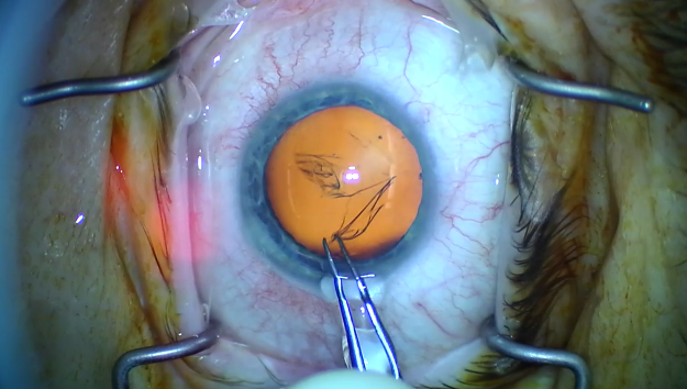 Routine Cataract Surgery