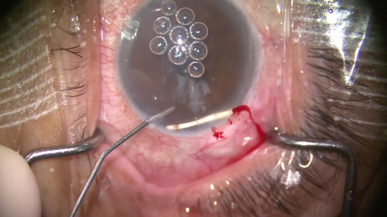 Ozurdex Explant No-Touch Technique