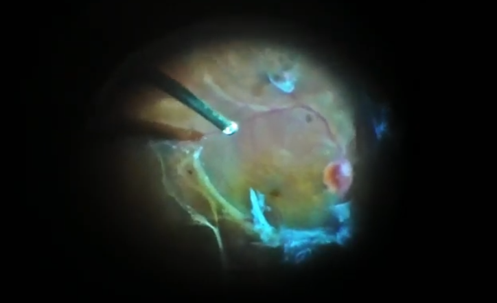 Severe Diabetic Retinopathy With Membrane Stripping and Relaxing Retinotomies