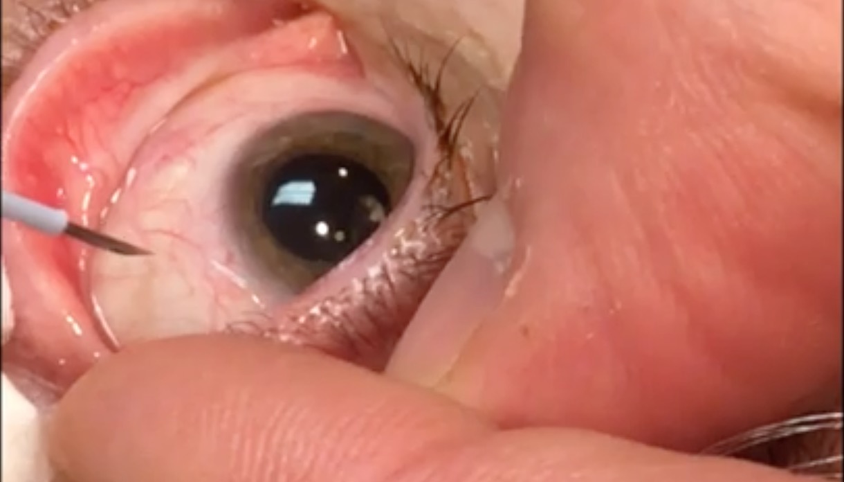 Ozurdex Injection Technique