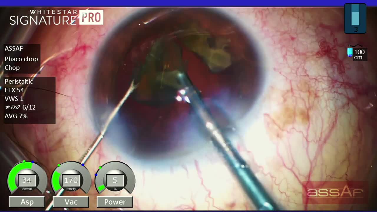 Quick Chop for N4+ Cataract