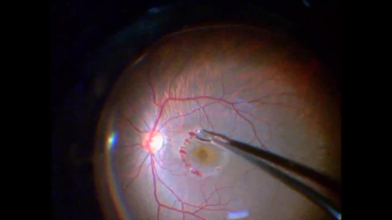 Inverse ILM Flap Technique for Large Macular Hole