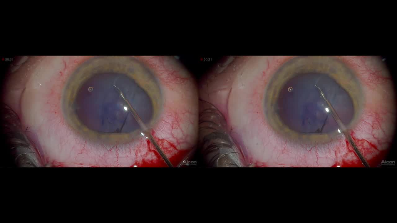 Traumatic Cataract Surgery With the NGENUITY 3-D System (Alcon)