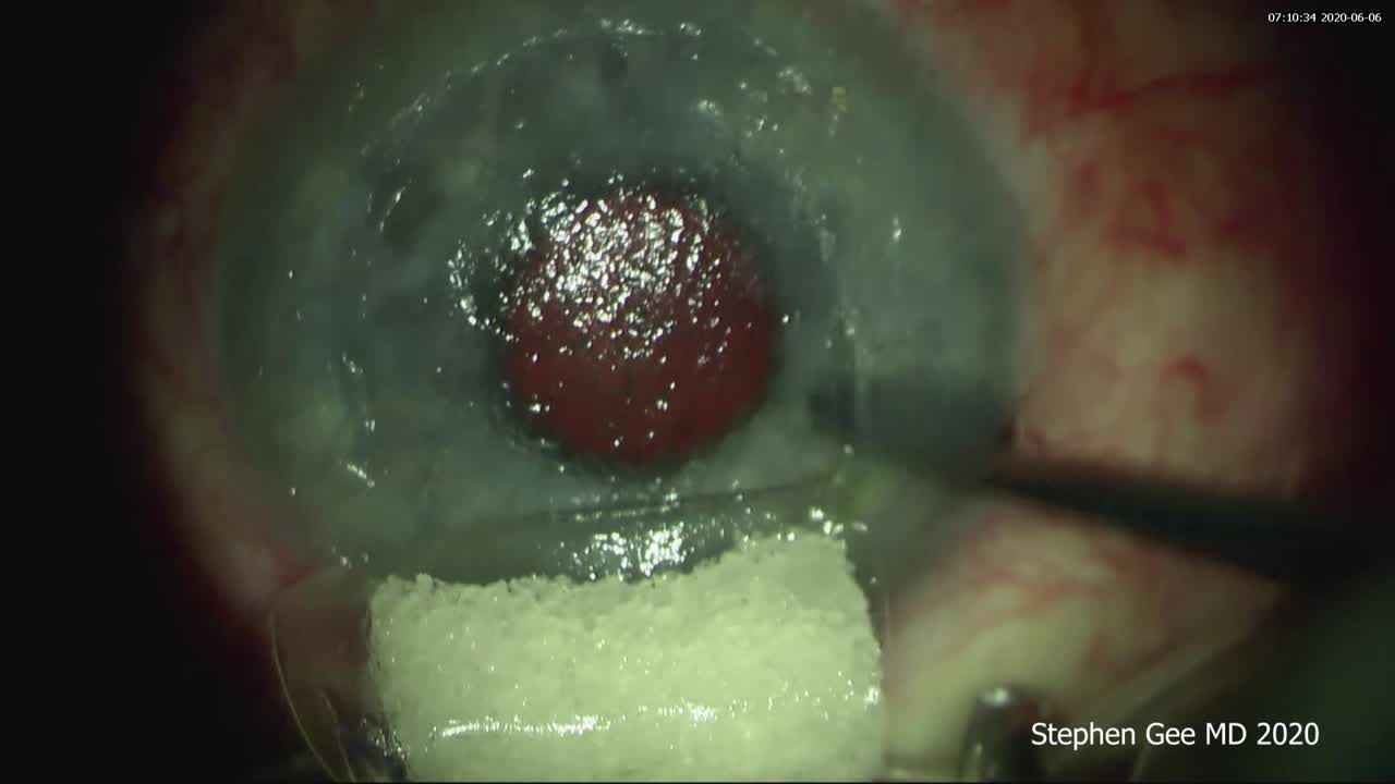 Repair of a Chronic Traumatic LASIK Flap Dislocation