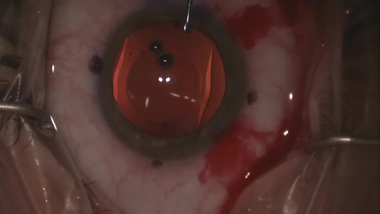 Toric ICL Placement